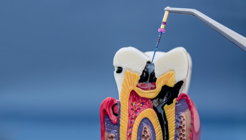 Root Canal Treatment