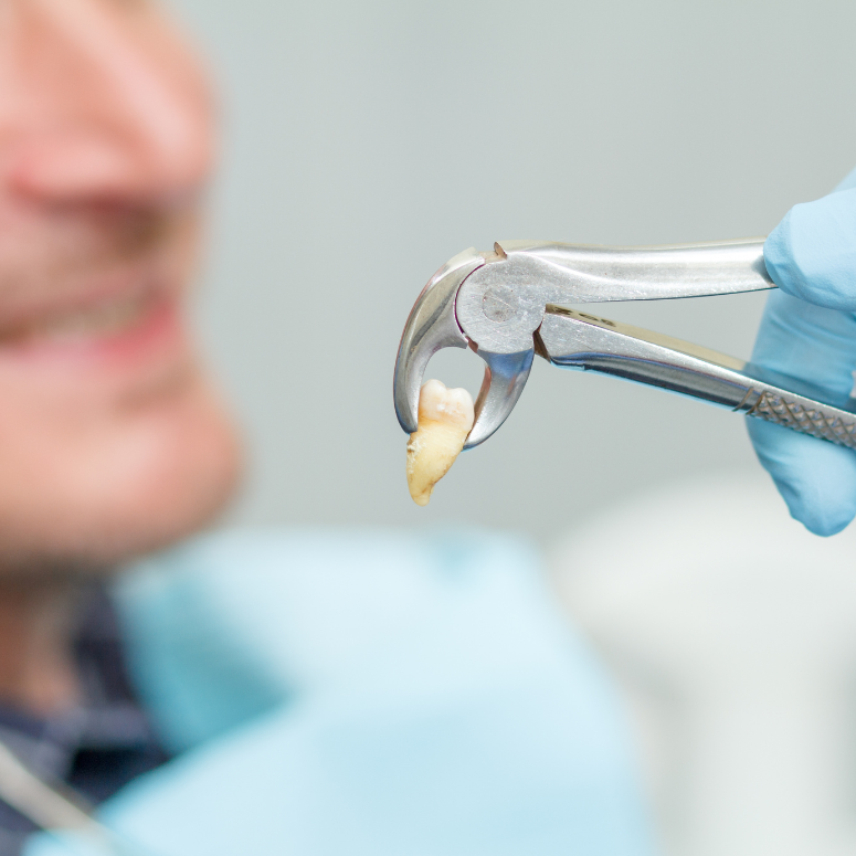 Tooth Extractions